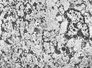 M,44y. | spleen - Gaucher disease M,44y. | spleen - Gaucher disease